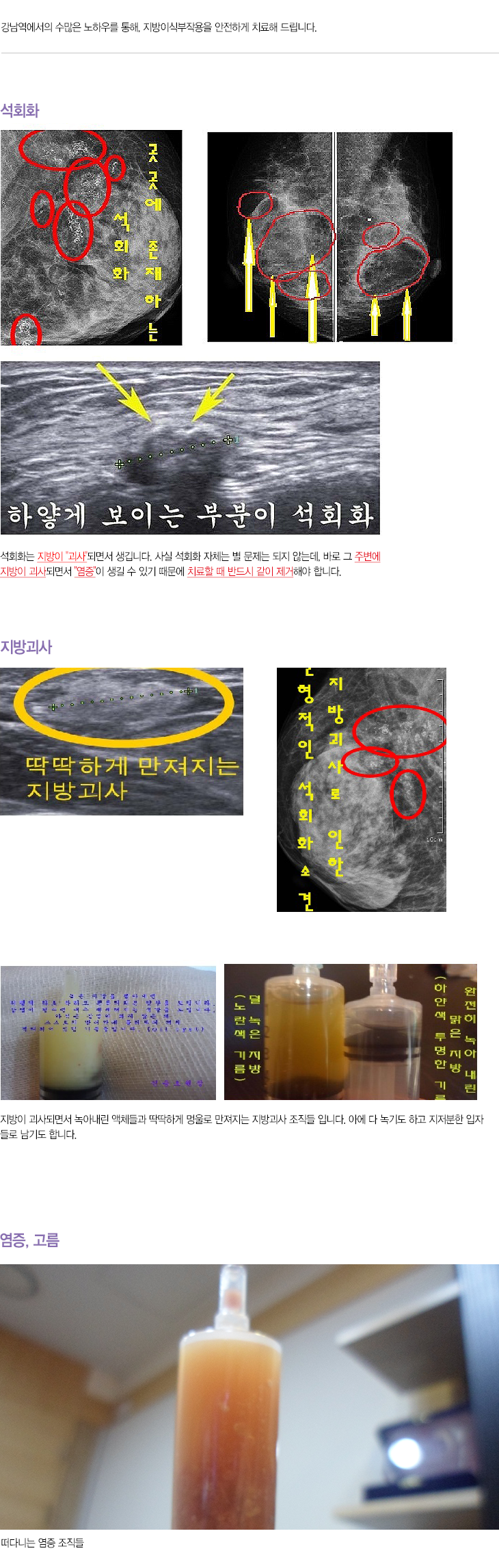 지방이식부작용