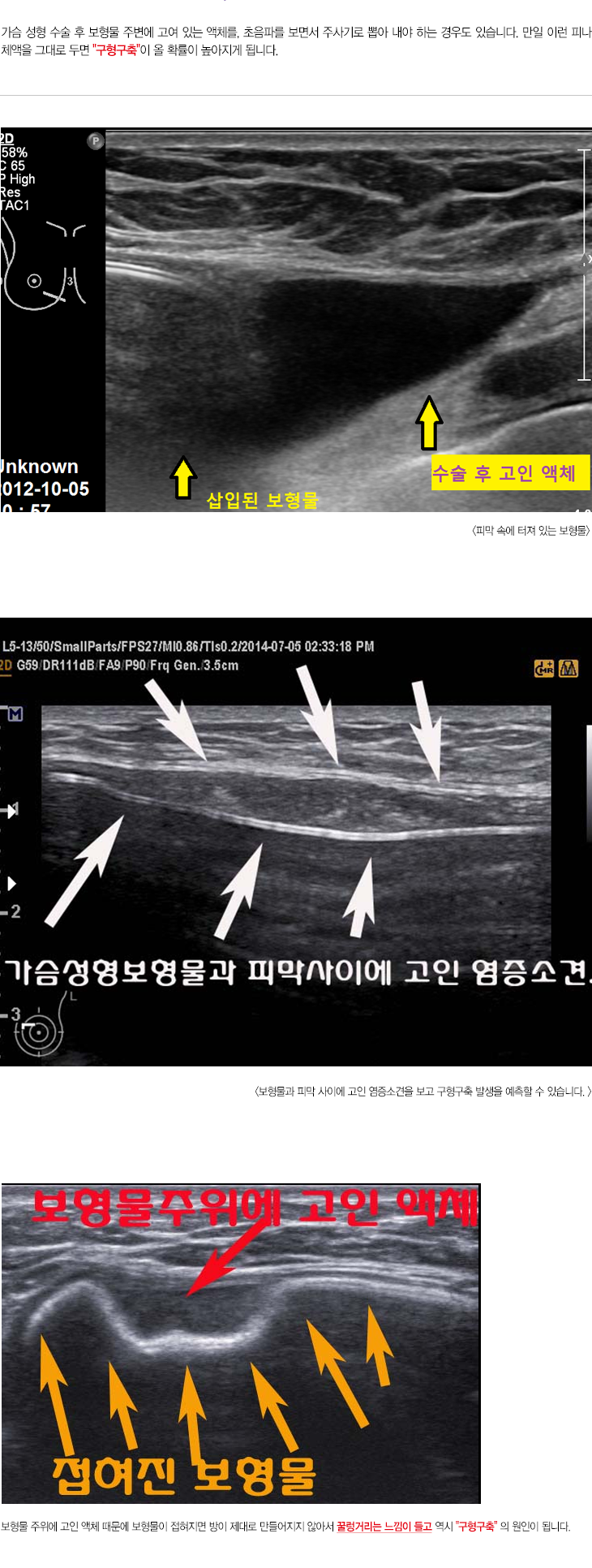 가슴성형전후보형물,유방검사