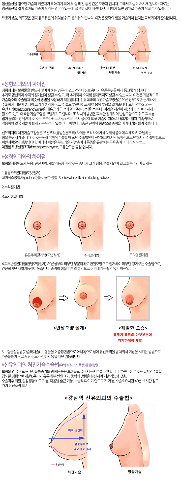 처진가슴(유방실질 플랩 재배치법)